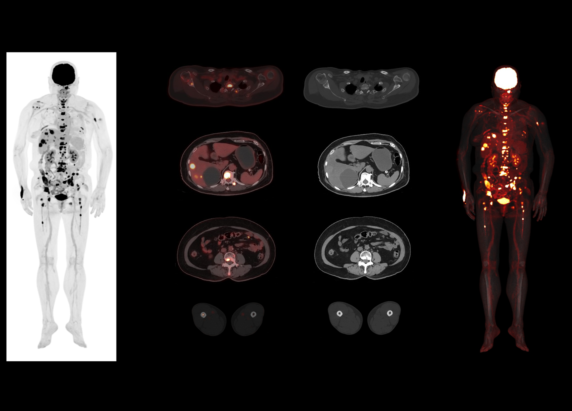 p10 Clear Delineation of Lesions from Vertex to Toe in 4 min