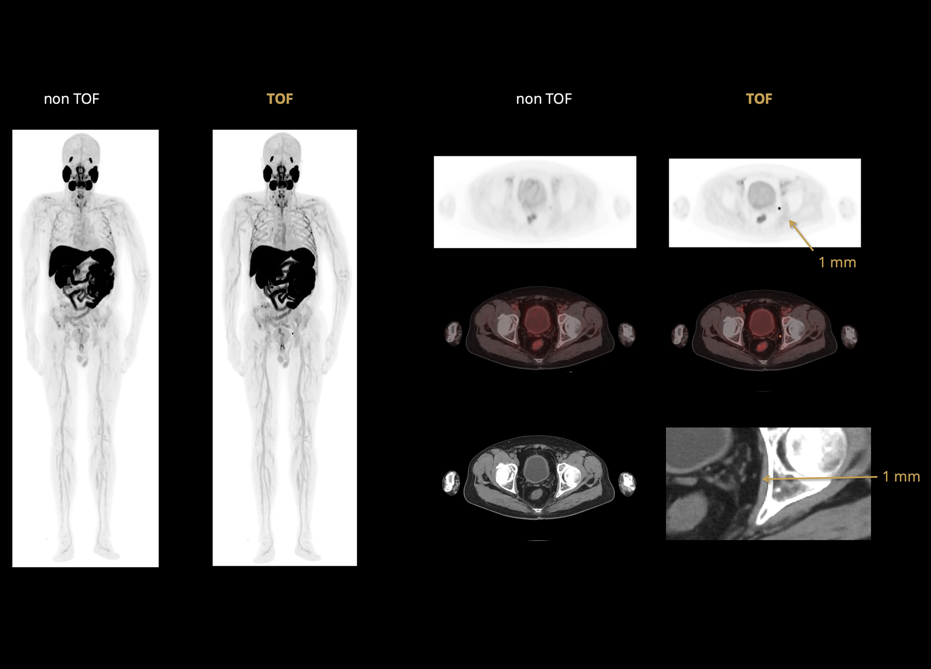 p11 Improving Small Lesion Detectability and Delineation with 219 ps TOF Resolution