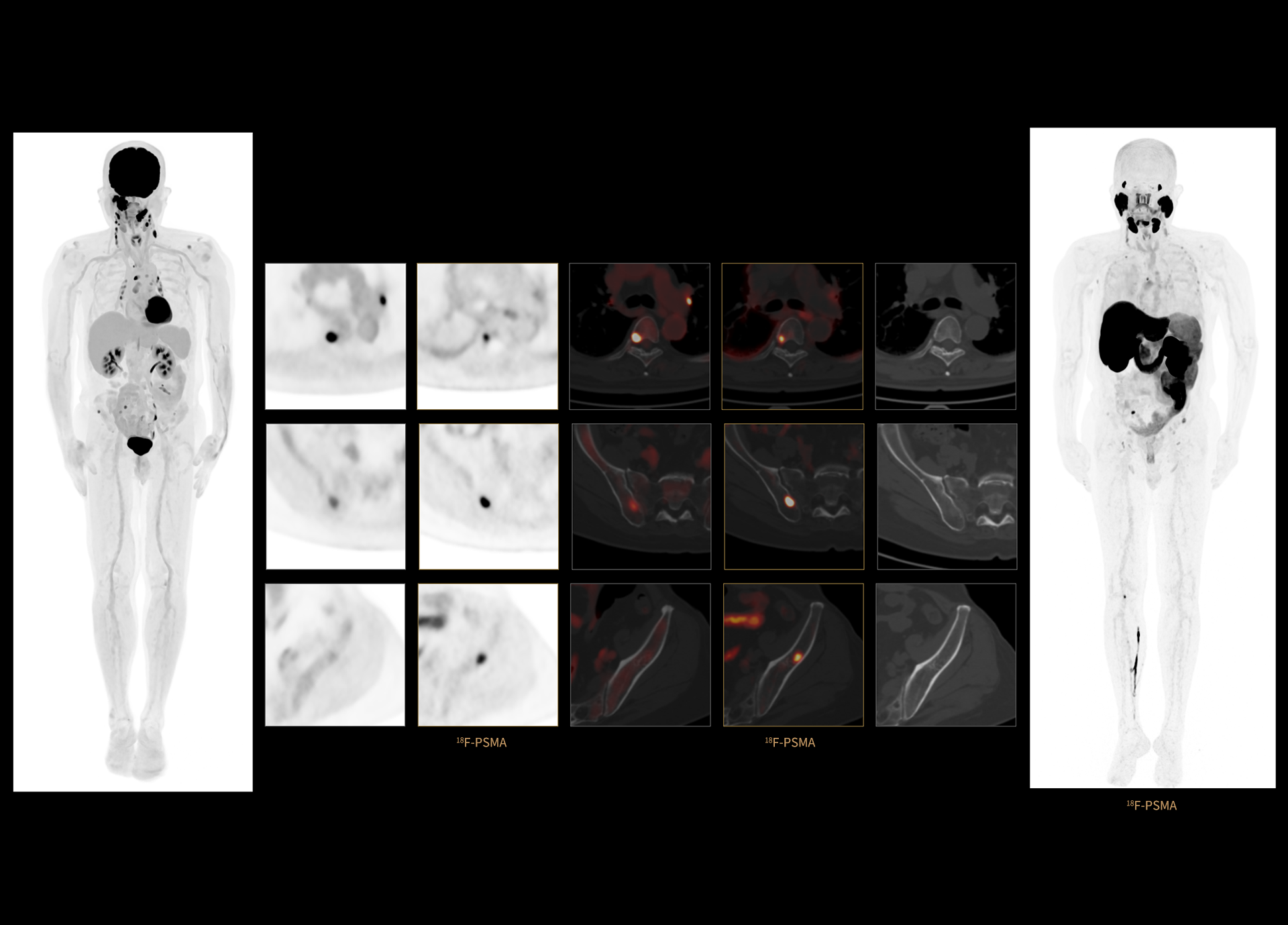 p16 Dual-Tracer Scan of Patient with Multiple Myeloma