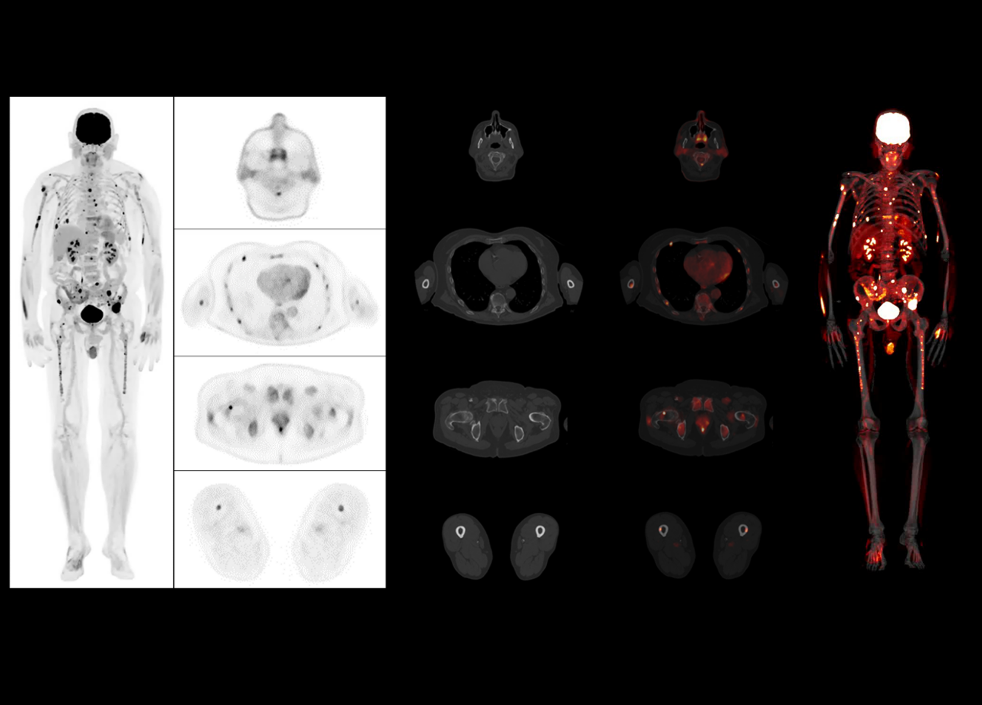 p7 High Resolution PET/CT Imaging Enables Detecting Small Lesions