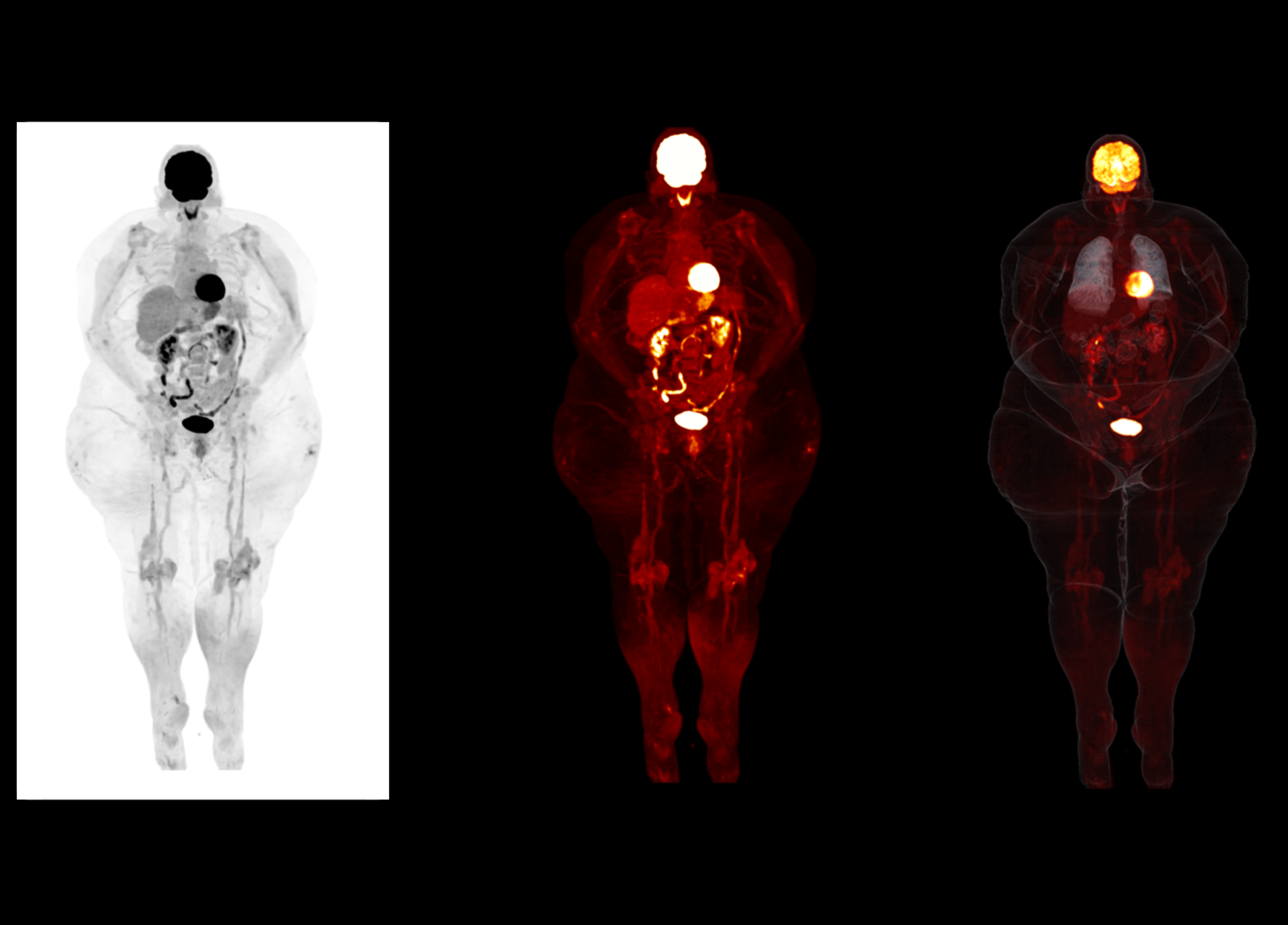 p8 High Resolution PET/CT Imaging Enables Detecting Small Lesions